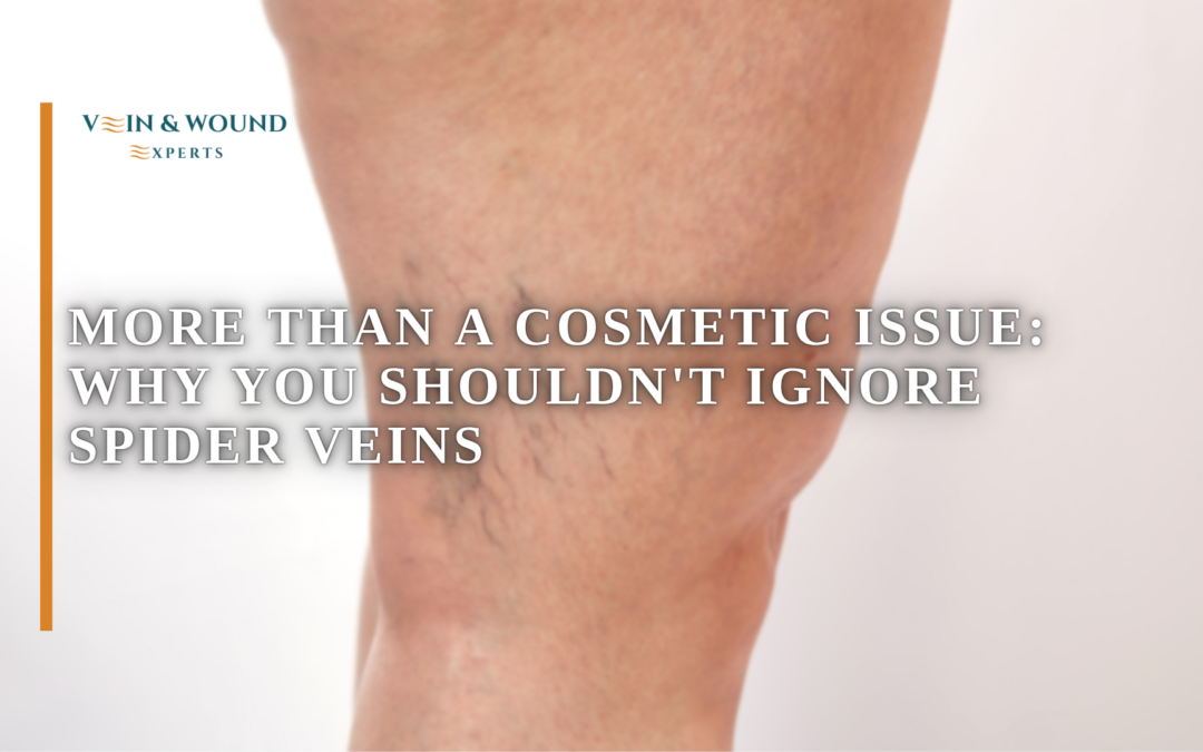 More Than a Cosmetic Issue: Why You Shouldn’t Ignore Spider Veins