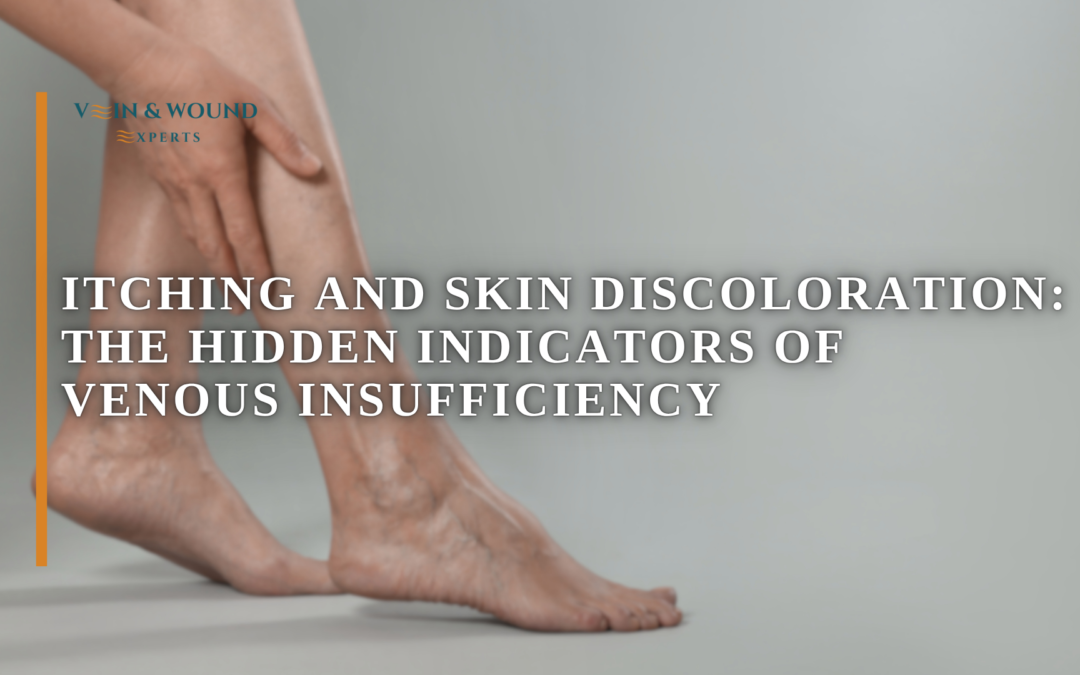 Itching and Skin Discoloration: The Hidden Indicators of Venous Insufficiency