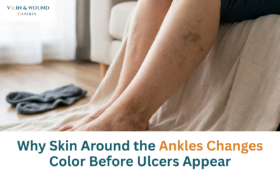 Why Skin Around the Ankles Changes Color Before Ulcers Appear