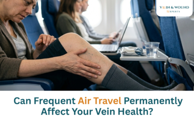 Can Frequent Air Travel Permanently Affect Your Vein Health?