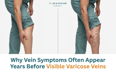 Why Vein Symptoms Often Appear Years Before Visible Varicose Veins