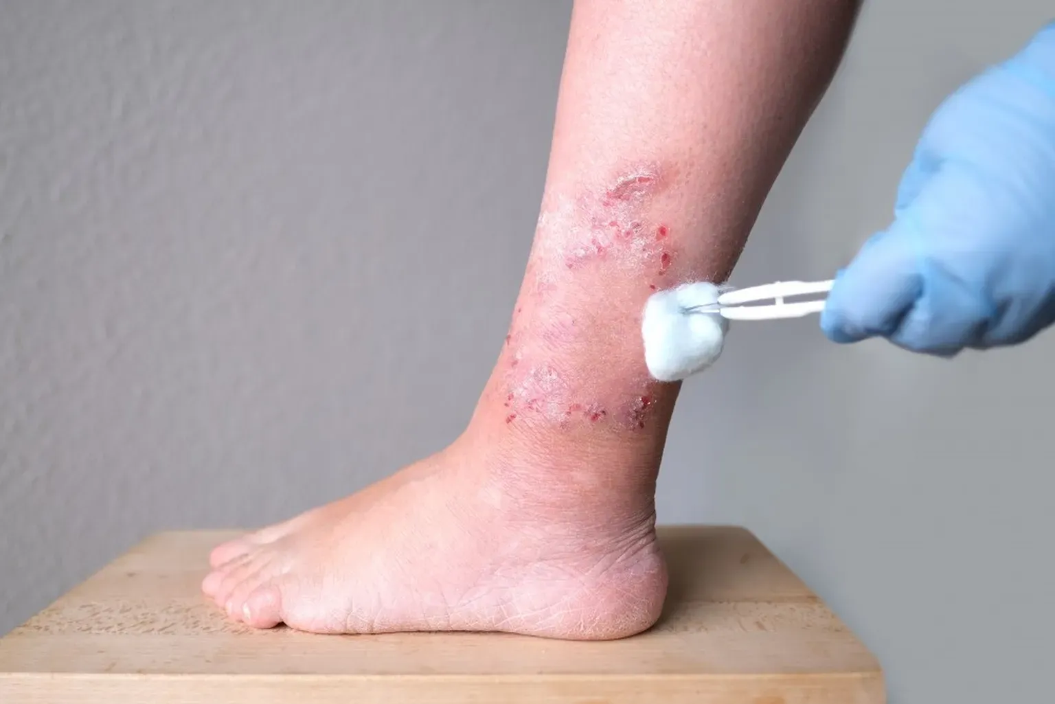 Slow-healing leg wound caused by poor circulation.