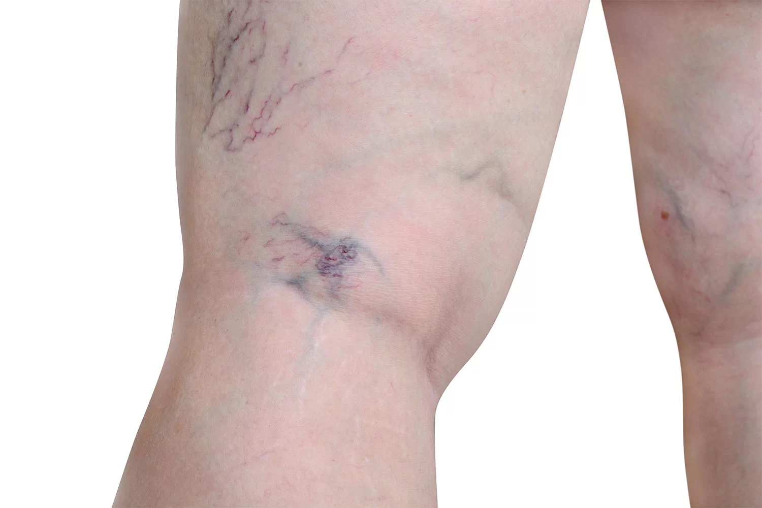Close-up of legs showing early vein issues before visible varicose veins develop.