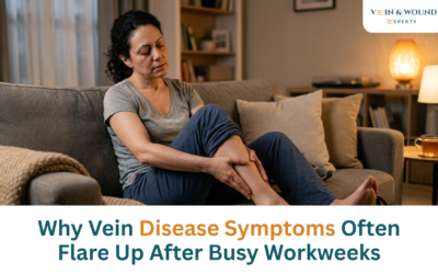 Why Vein Disease Symptoms Often Flare Up After Busy Workweeks