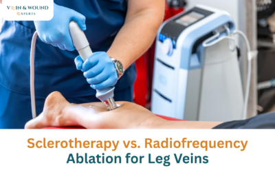 Sclerotherapy vs. Radiofrequency Ablation for Leg Veins
