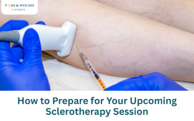 How to Prepare for Your Upcoming Sclerotherapy Session