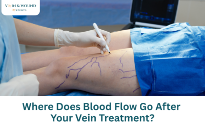 Where Does Blood Flow Go After Your Vein Treatment?