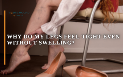 Why Do My Legs Feel Tight Even Without Swelling?