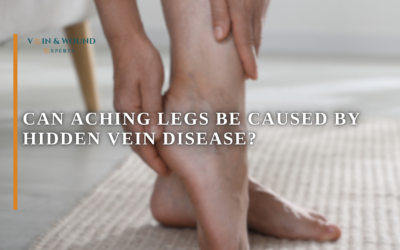 Can Aching Legs Be Caused by Hidden Vein Disease?