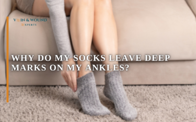Why Do My Socks Leave Deep Marks on My Ankles?