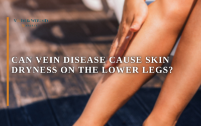 Can Vein Disease Cause Skin Dryness on the Lower Legs?