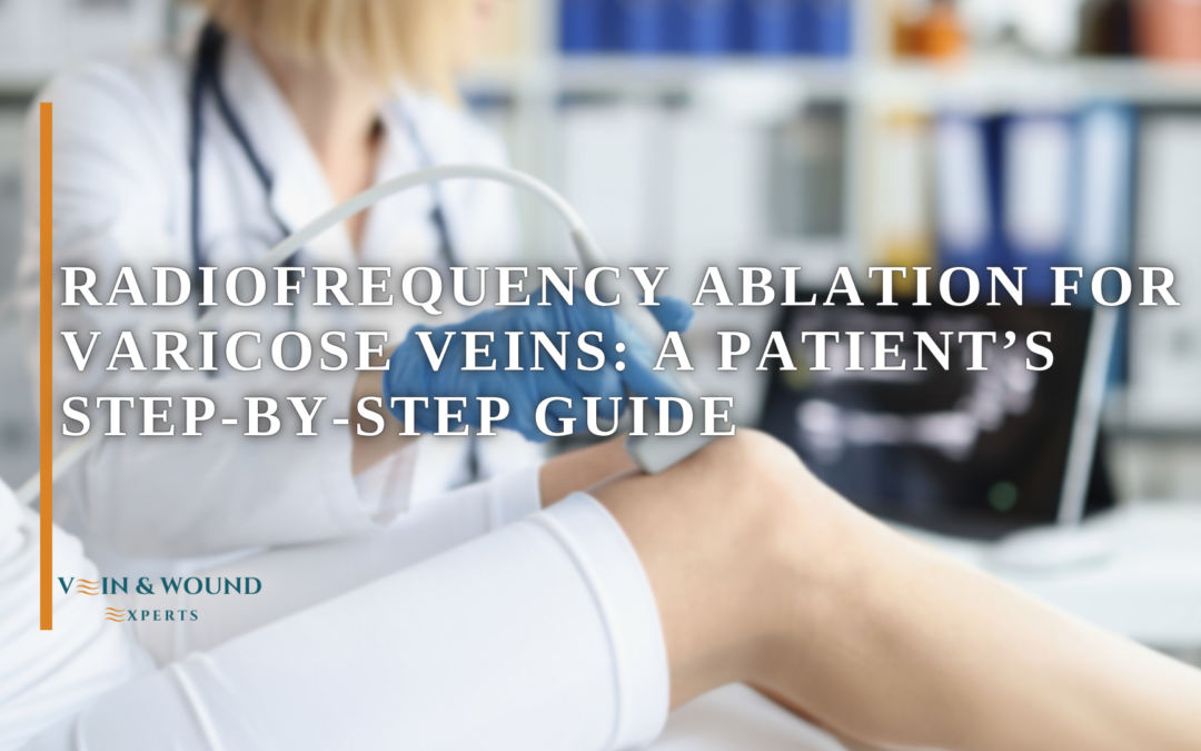 Radiofrequency Ablation for Varicose Veins: A Patient’s Step-by-Step Guide
