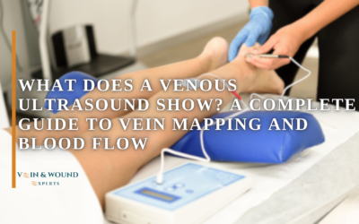 What Does a Venous Ultrasound Show? A Complete Guide to Vein Mapping and Blood Flow