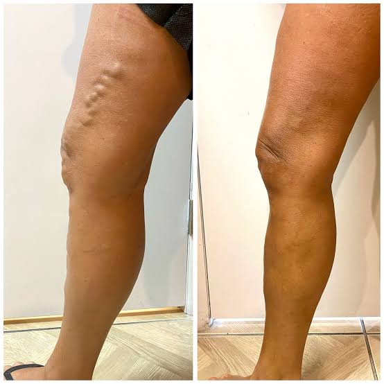 212 Before-and-after varicose vein treatment results.