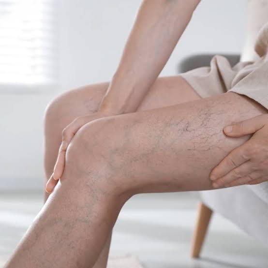 2123 </p>
<p>Alt text: Close-up of a swollen lower leg and foot with noticeable skin discoloration