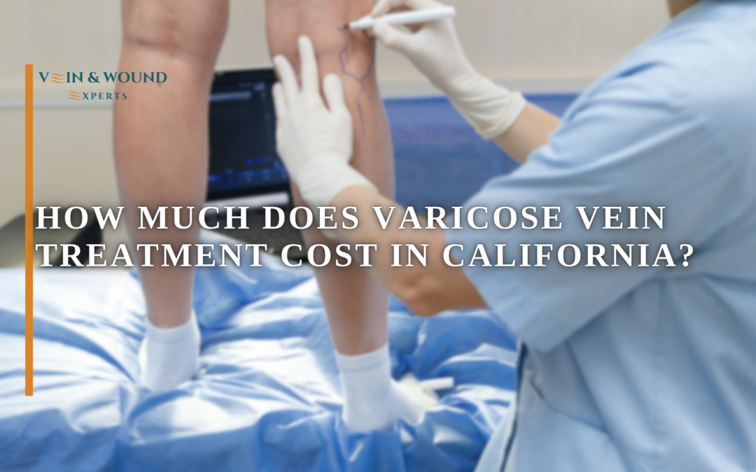 How Much Does Varicose Vein Treatment Cost in California?