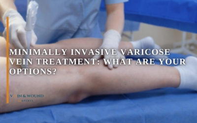 Minimally Invasive Varicose Vein Treatment: What Are Your Options?