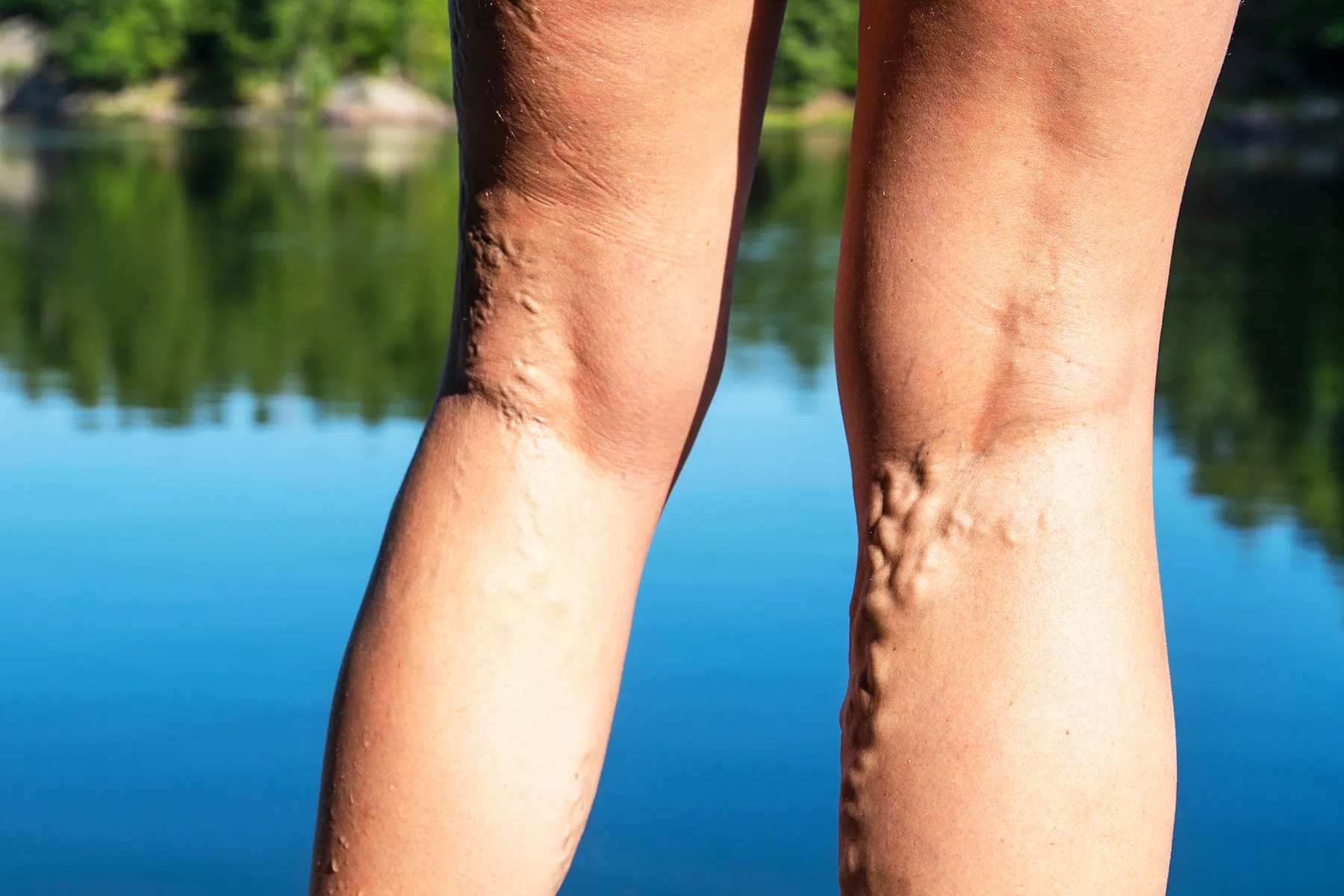 Close-up of visible, bulging varicose veins on the calf of a leg