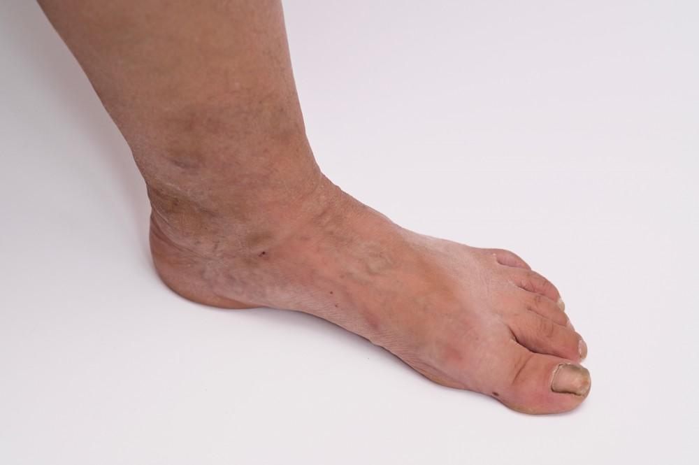 2312 Side view of a human foot and lower leg showing skin discolouration around the ankle
