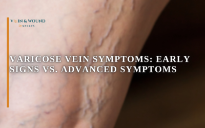 Varicose Vein Symptoms: Early Signs vs. Advanced Symptoms