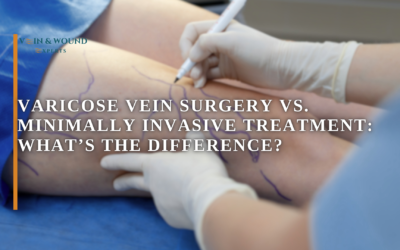 Varicose Vein Surgery vs. Minimally Invasive Treatment: What’s the Difference?